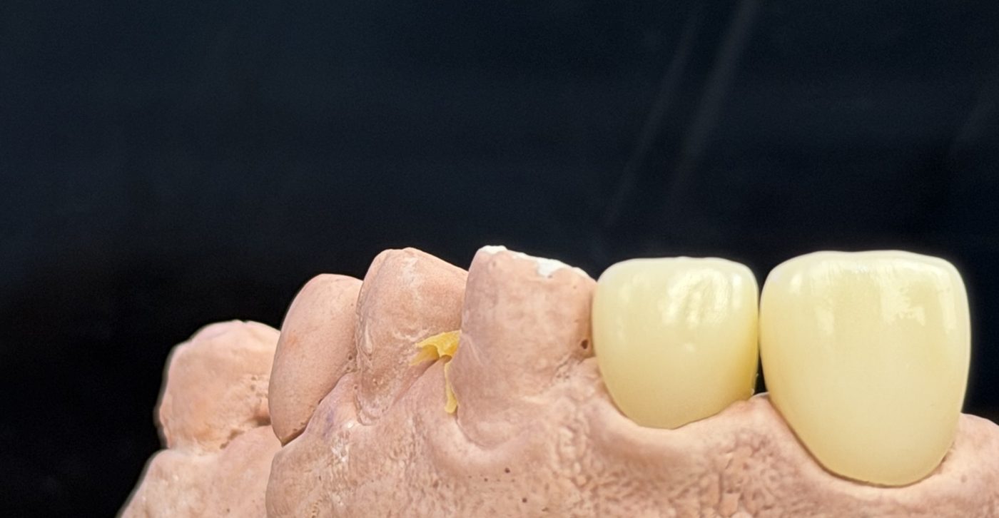Coronas anteriores sobre modelo — Laboratorio Dental NIX